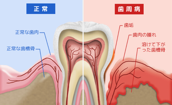 歯 周 病 症状
